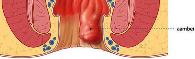 een afbeelding van een aambei in de anus