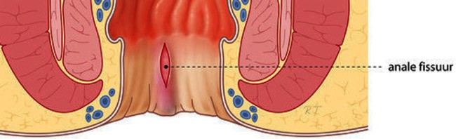 Op deze afbeelding is te zien waar de anale fissuur zich bevindt.
